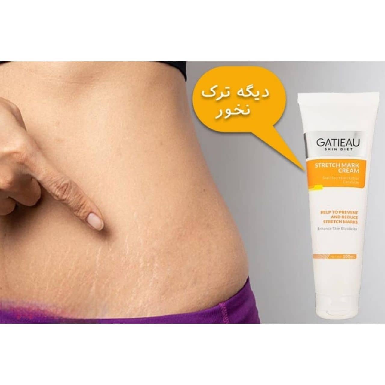 کرم رفع ترک پوستی گاتیو ( استرچ مارک )